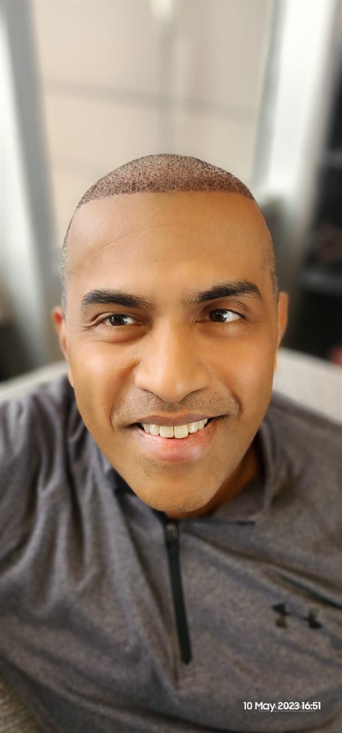 Dr. Ahmed after his hair transplant