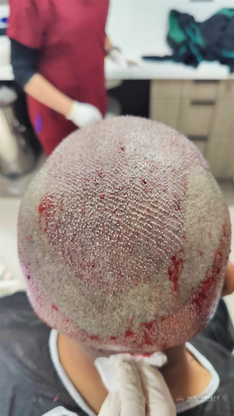 Dr. Ahmed: Day 0, immediately after