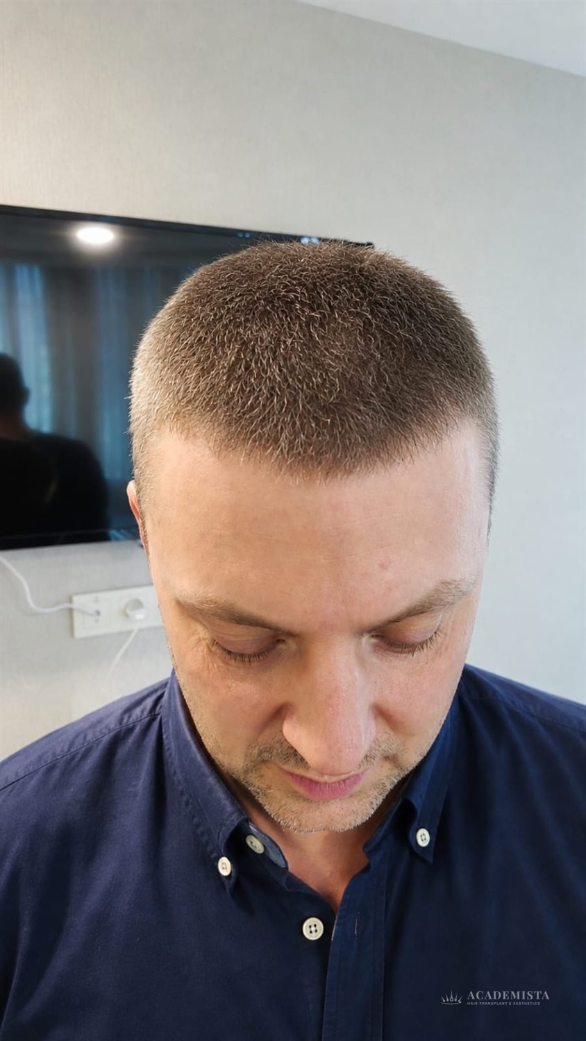 Alex after his hair transplant