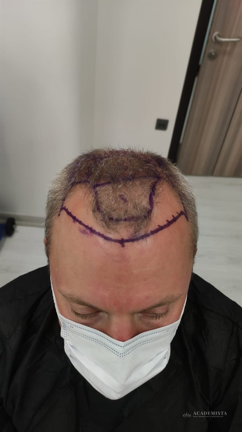 Alex before his hair transplant