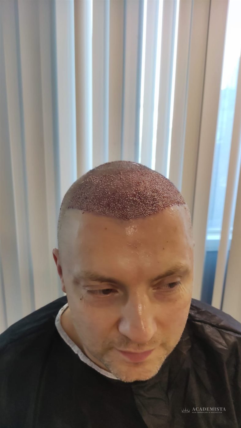 Alex: Day 0, after the procedure