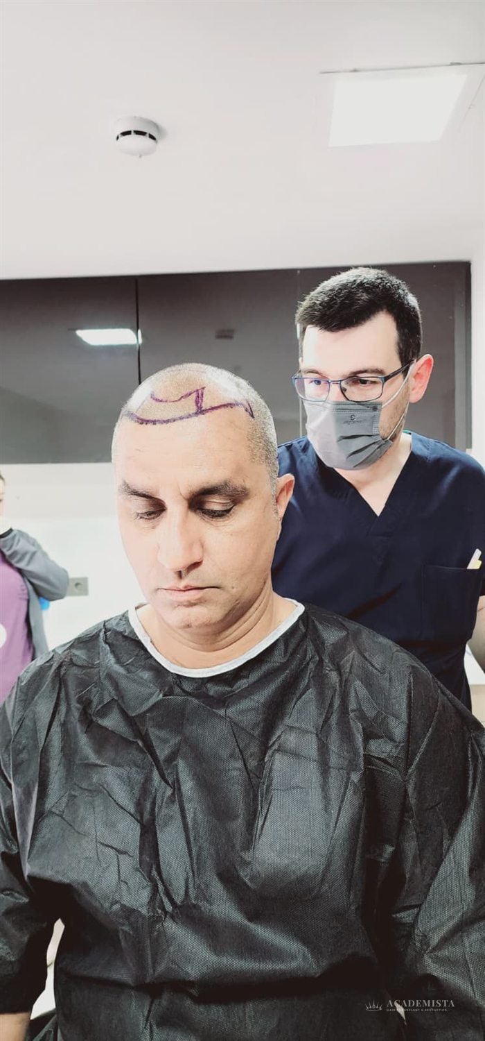 Atif before his hair transplant