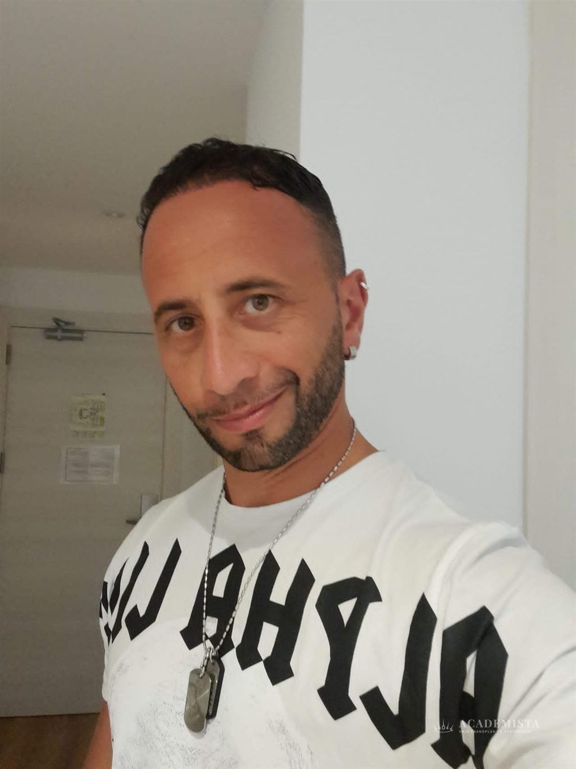 Franco after his hair transplant