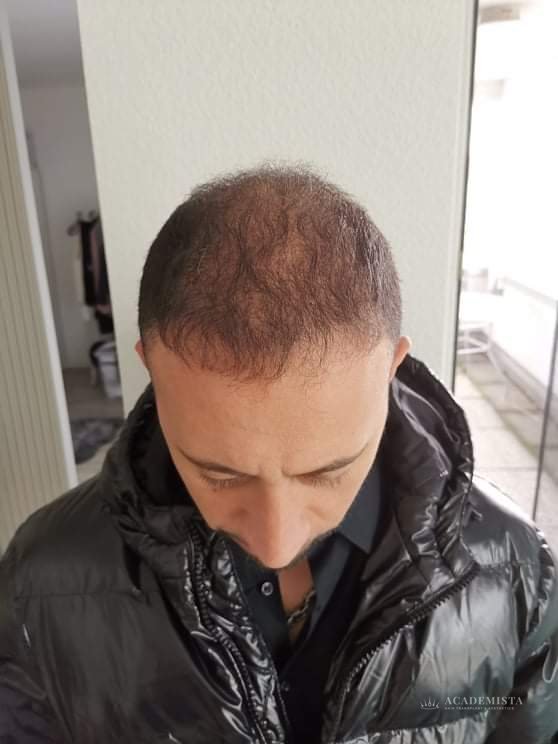 Franco before his hair transplant