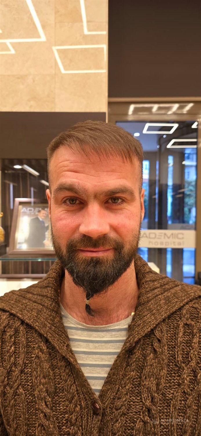 Gabriel after his hair transplant