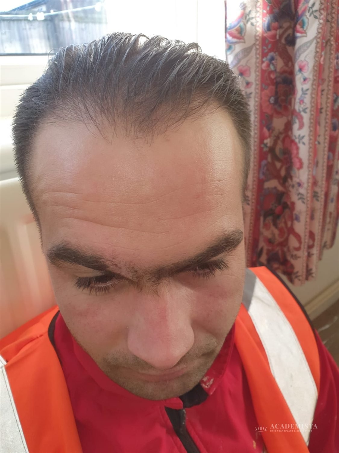 Gabriel before his hair transplant