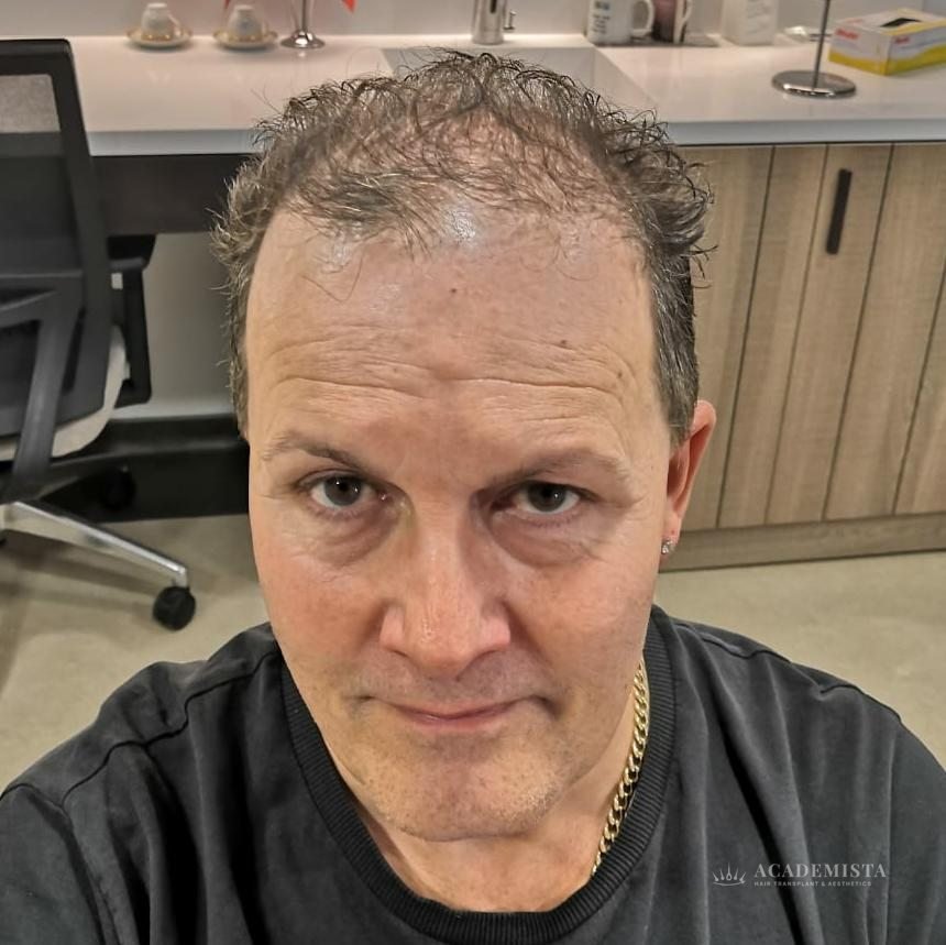 James before his hair transplant
