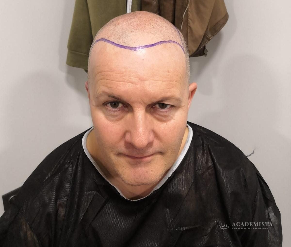 James: The hairline marked out
