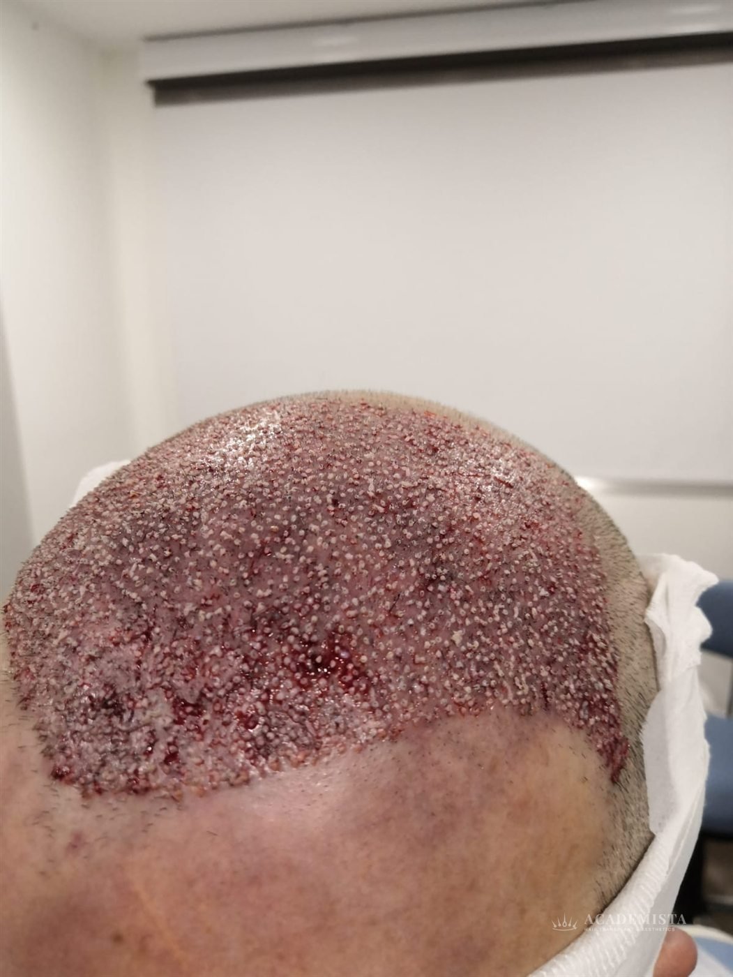 James: Day 0, immediately after the procedure