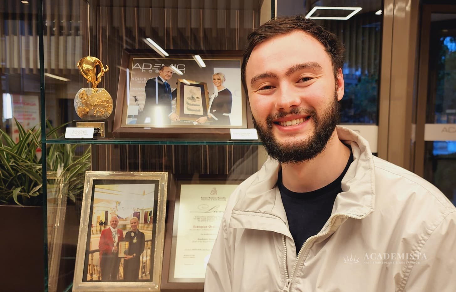 Julian after his hair transplant