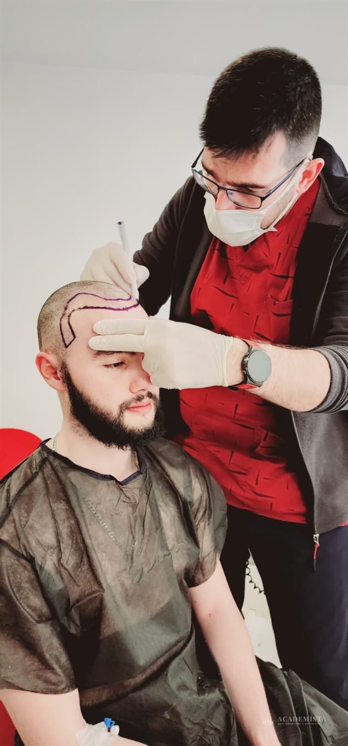 Julian before his hair transplant