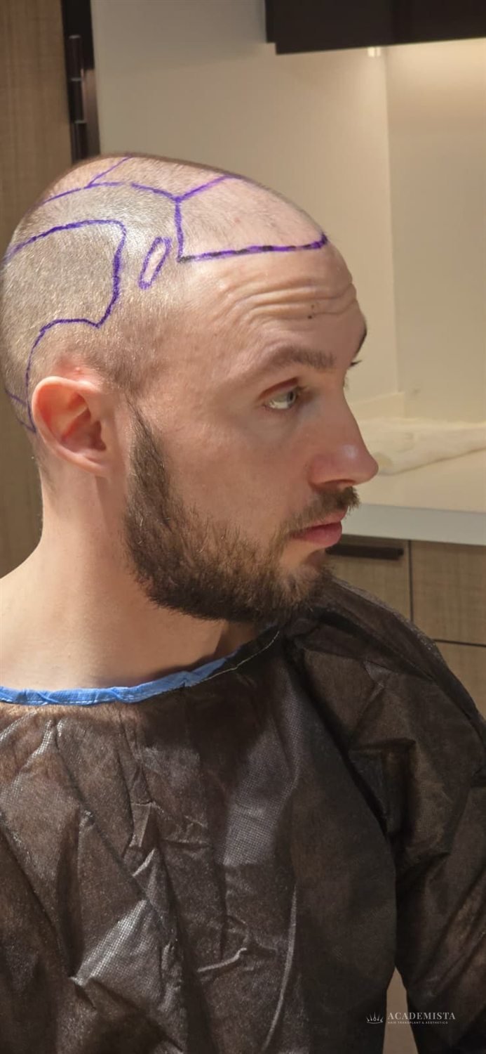 Lee before his hair transplant