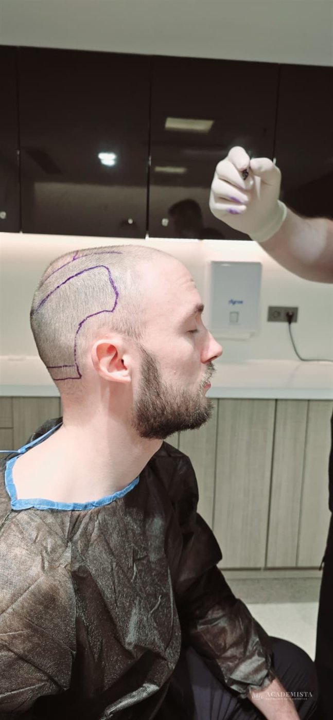 Lee: The hairline marked out