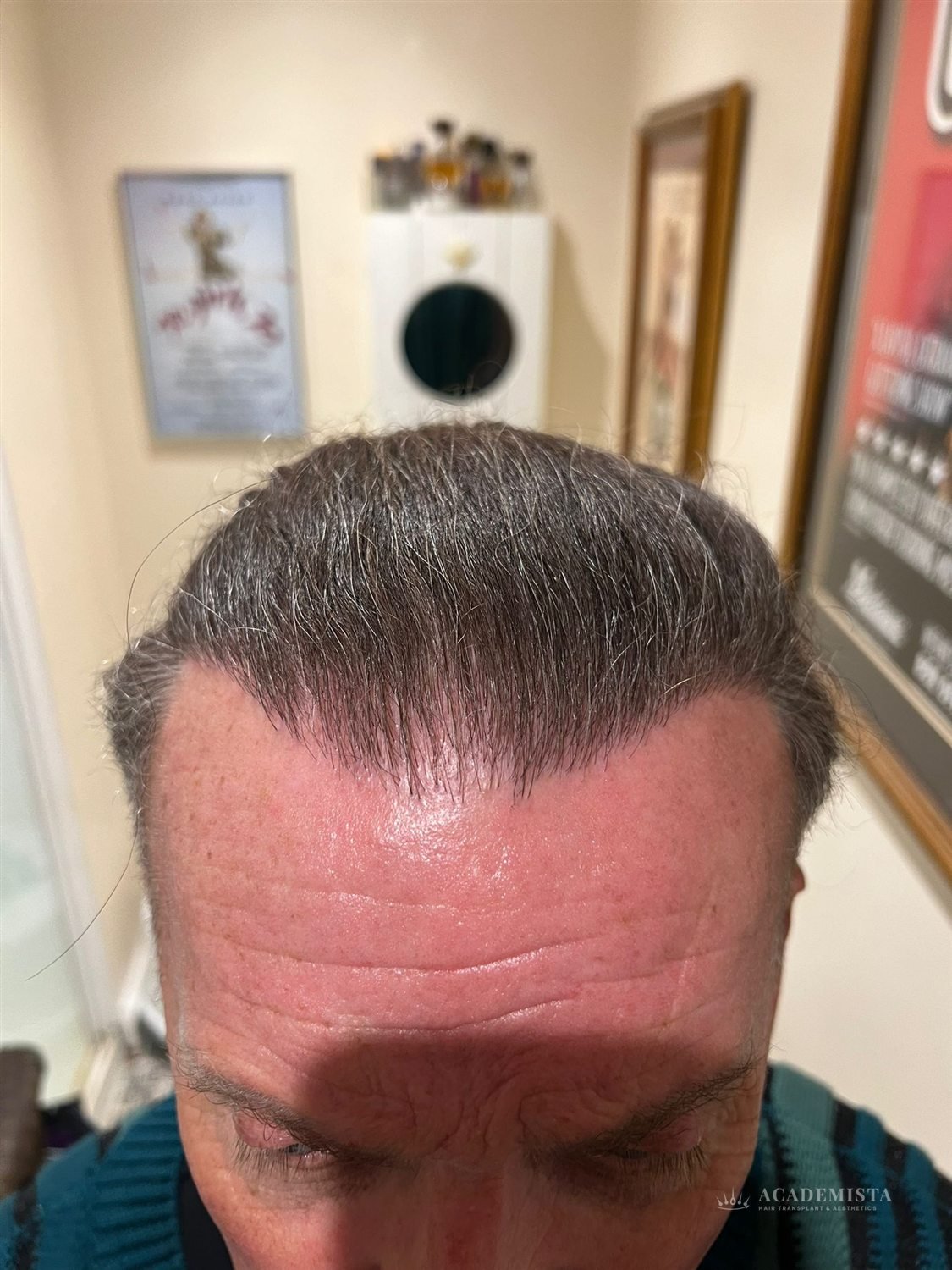 Lee after his hair transplant