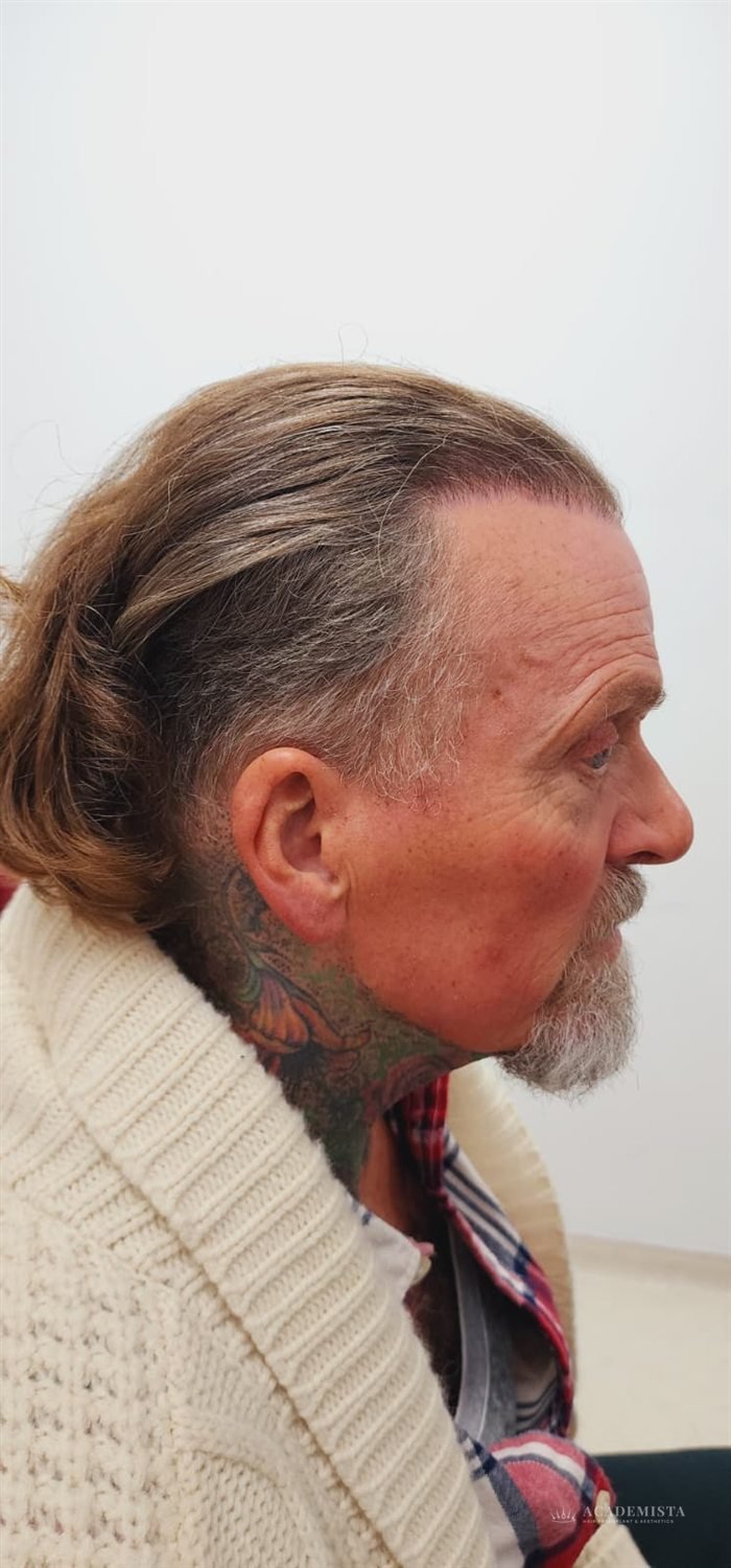 Lee before his hair transplant
