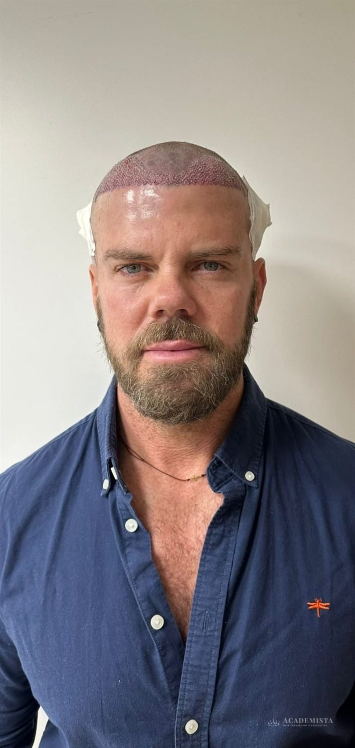 Lloyd before his hair transplant