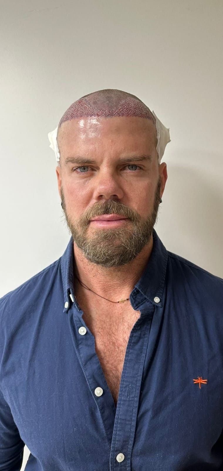 Patient immediately after his Sapphire FUE hair transplant, implanted grafts visible along the new hairline