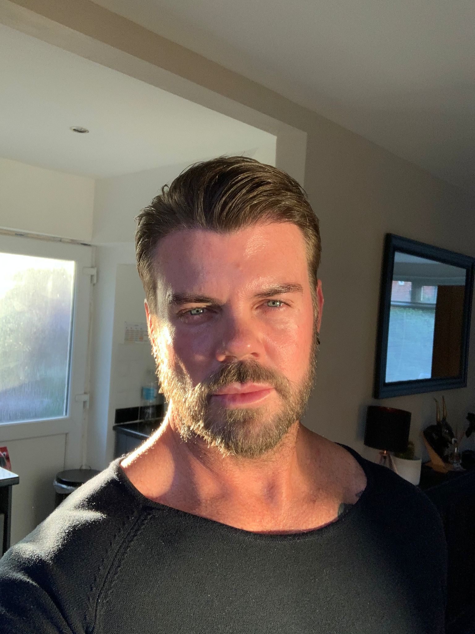 The same patient after regrowth with a full, styled head of hair