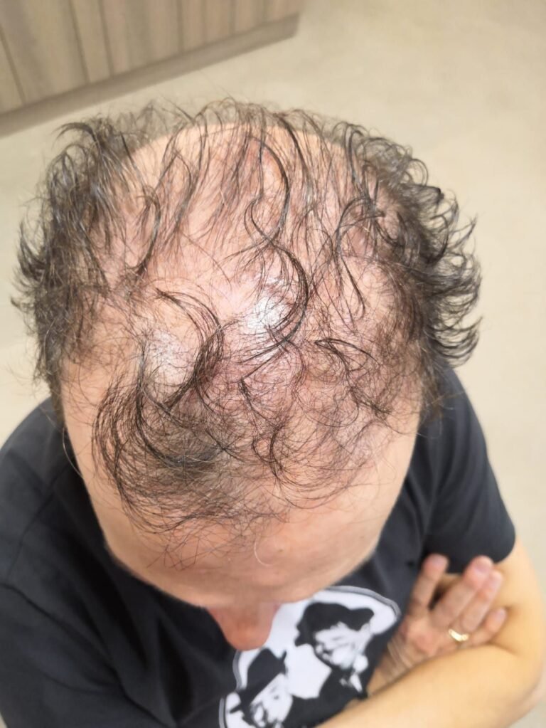Diffuse thinning before treatment
