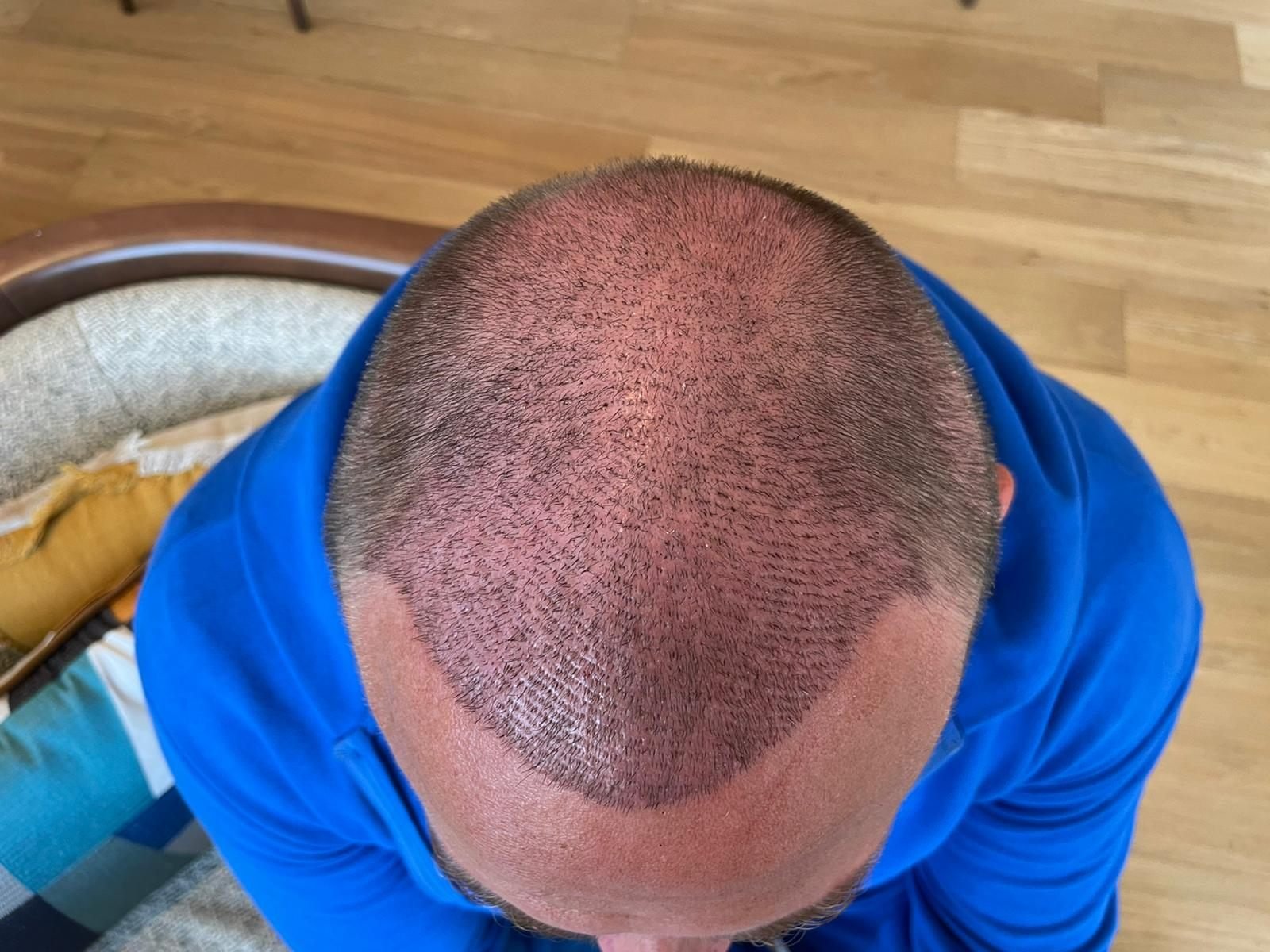 Top-down view of a healing scalp in the early weeks after transplant, redness and scabbing visible