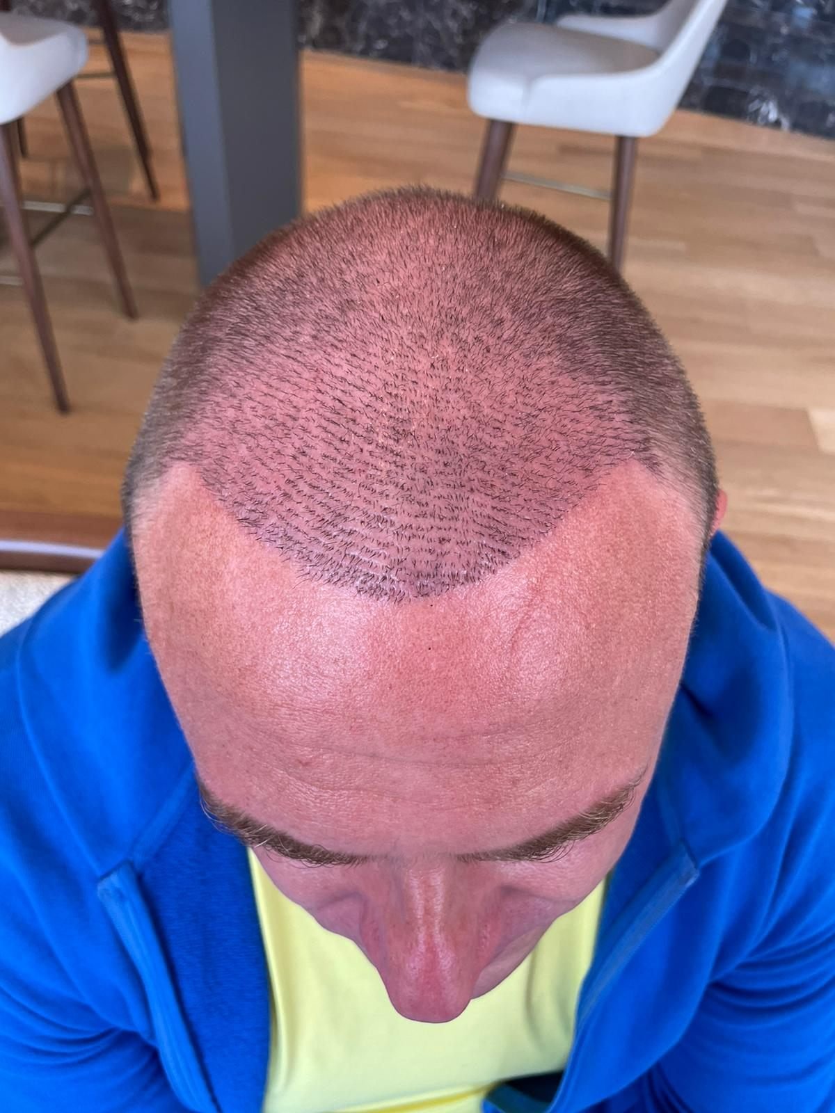 The same scalp months later with new growth filling in