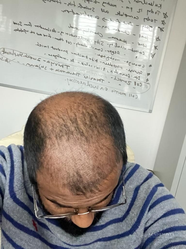 Phinil Tomas before his hair transplant
