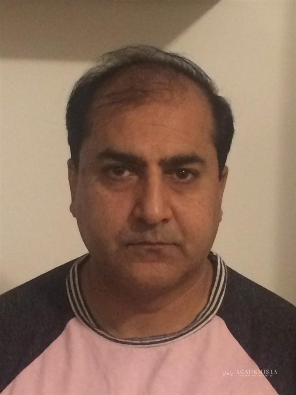Sami before his hair transplant