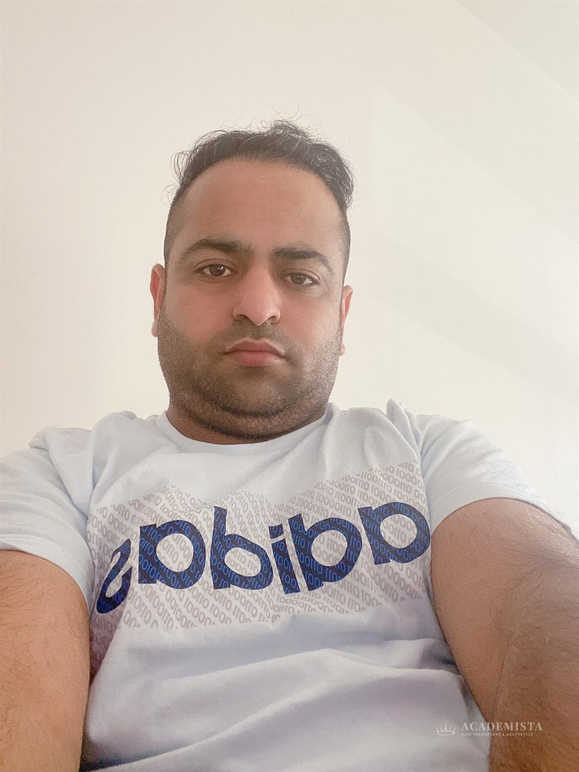Shahbaz after his hair transplant