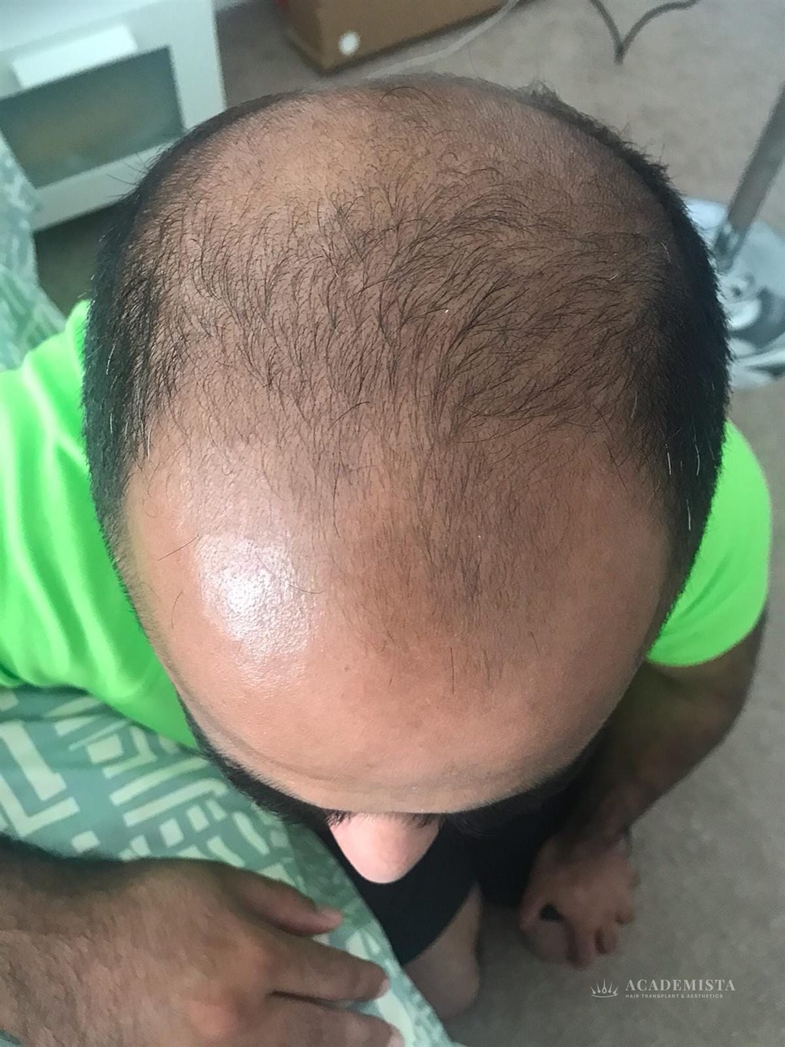 Shahbaz before his hair transplant