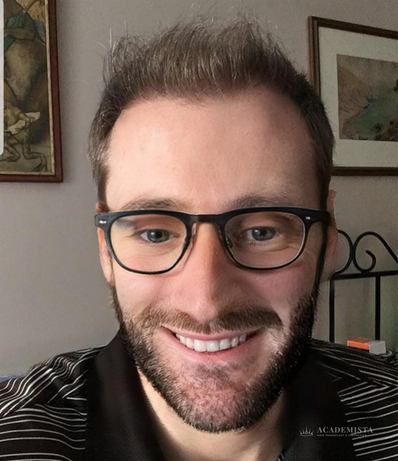 Simon after his hair transplant