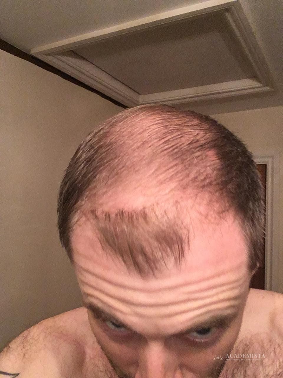 Simon before his hair transplant