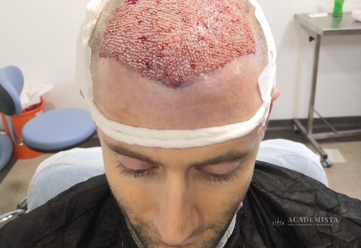 Simon: Day 0, after the procedure