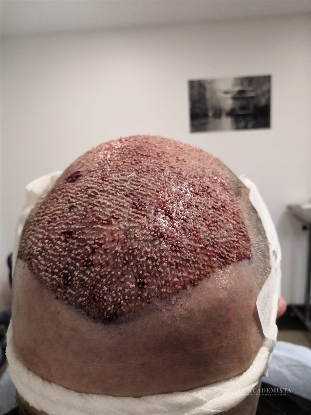 Simon: The implanted area from above