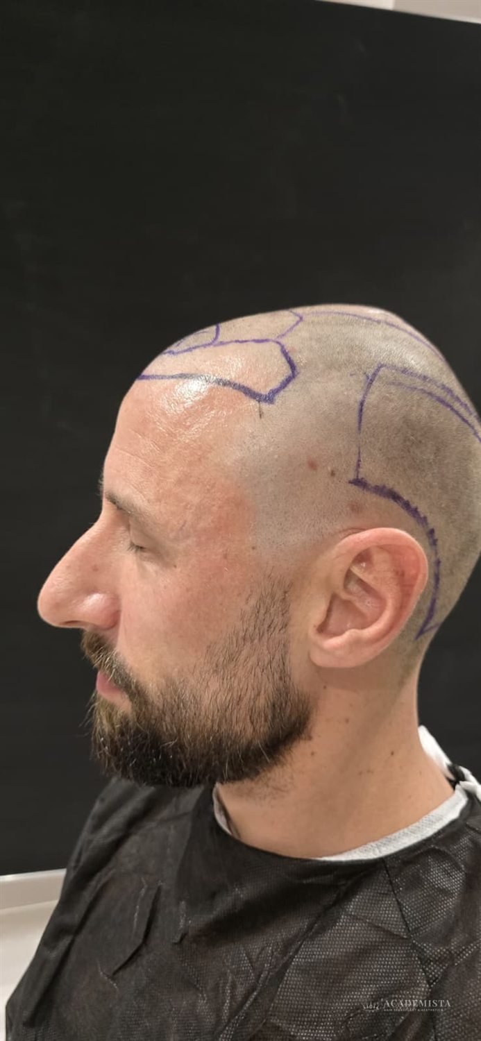 Stefan before his hair transplant