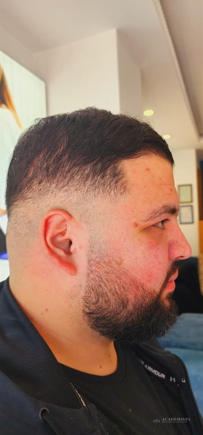 Yusuf after his hair transplant