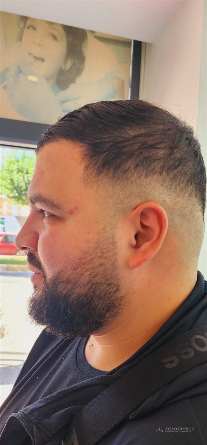 Yusuf before his hair transplant